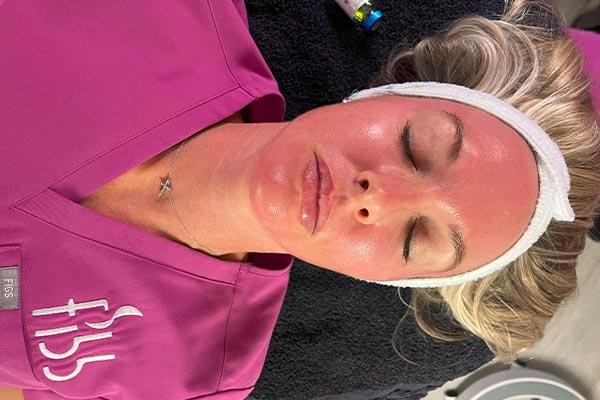 BioReelPeel Treatment Performed At FIBB