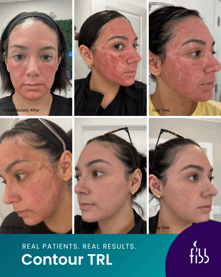Contour TRL Before & After Series