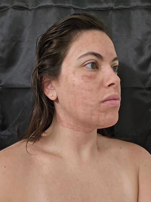 NanoLaserPeel™ Day 1 Post treatment
