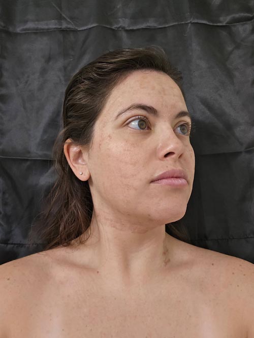 NanoLaserPeel™ day 3 results