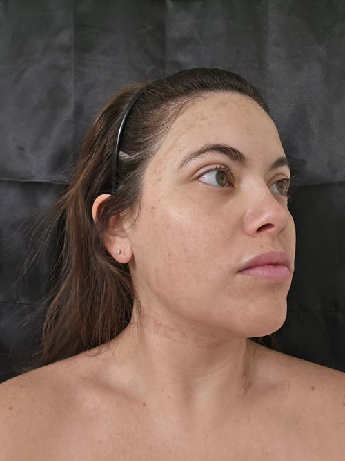 NanoLaserPeel™ day 4 results