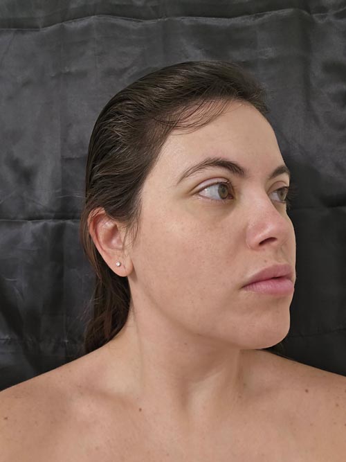 NanoLaserPeel™ day 5 results