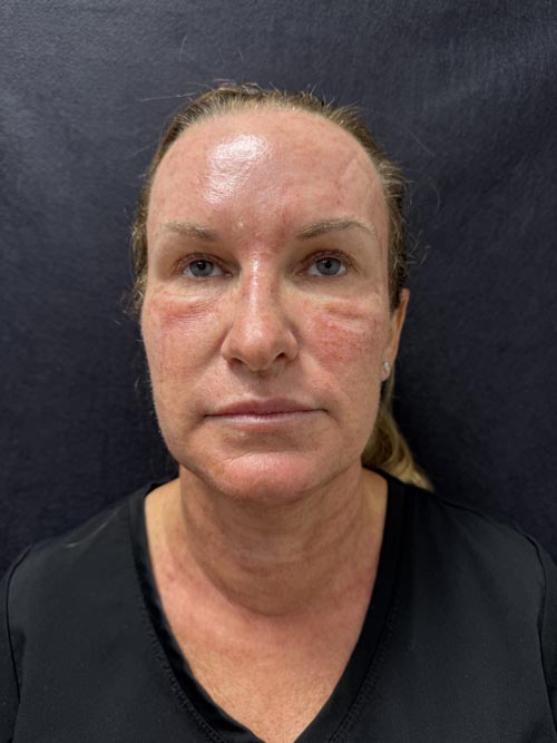 NanoLaserPeel™ day 1